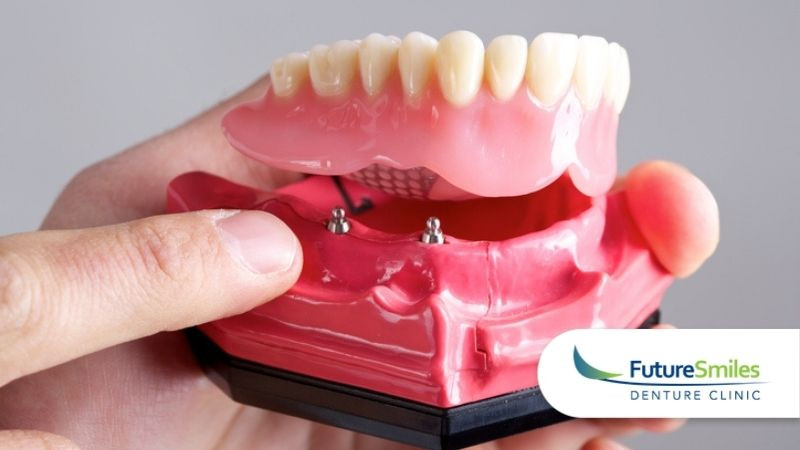 Top 5 Reasons to Consider Denture Implants in Calgary